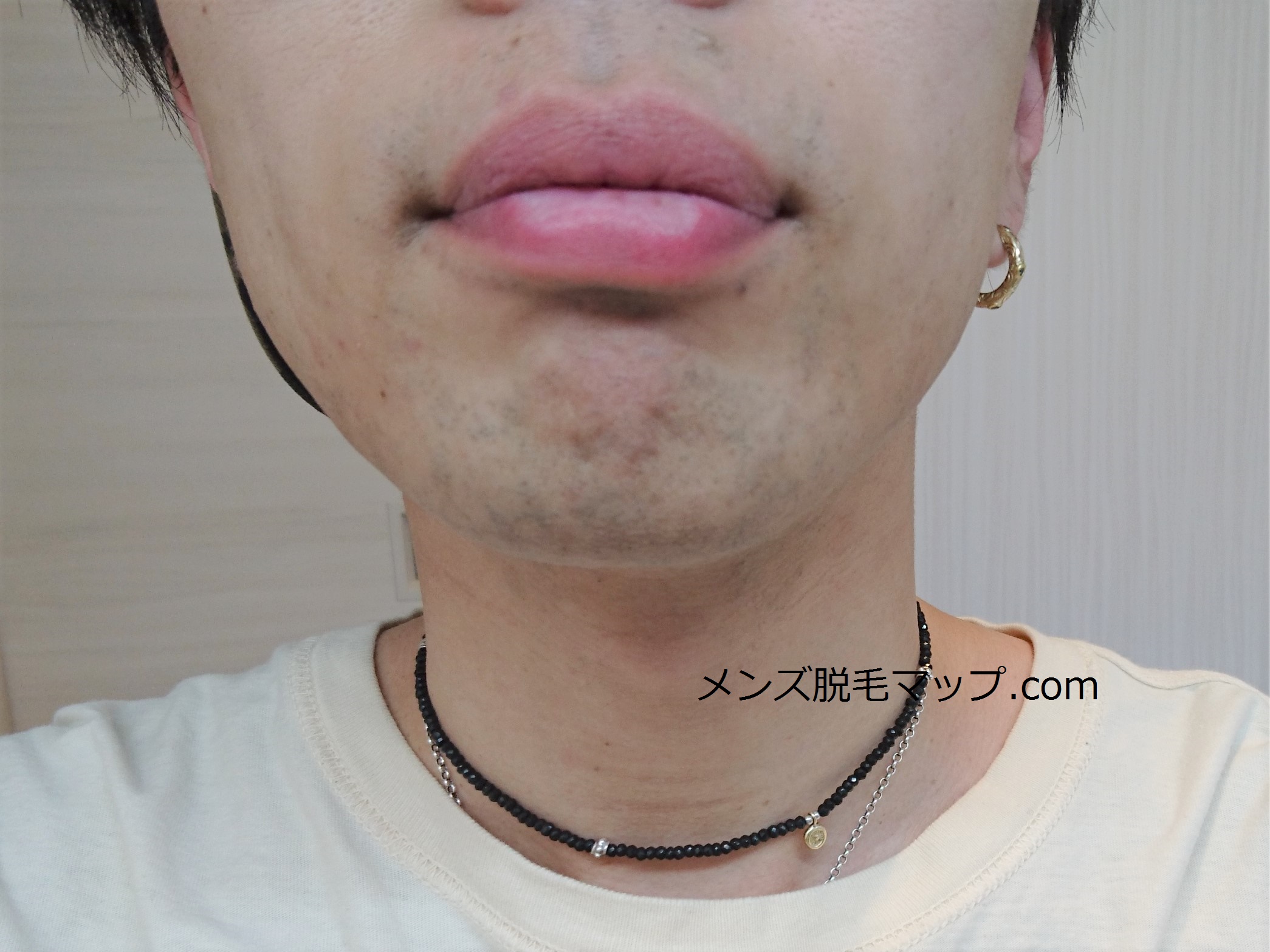 【ヒゲ脱毛】医療脱毛体験談！何回で綺麗になれるのか！？（３回目）